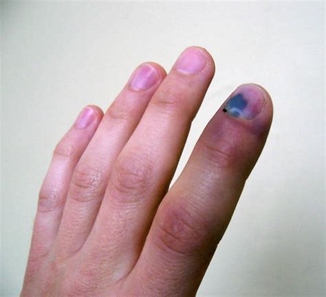 When should I be worried about a smashed finger?