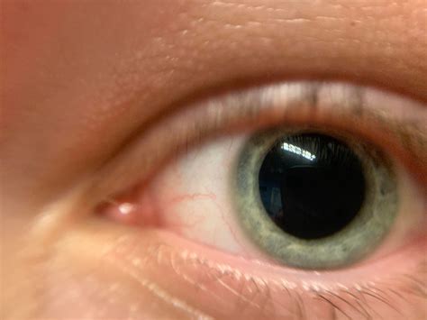 When should I be worried about enlarged pupils?