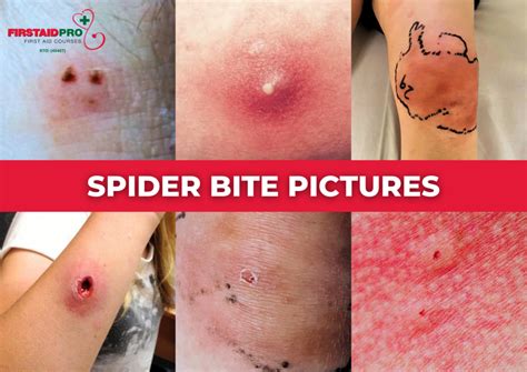 When should I worry about a spider bite?