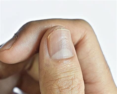 When should I worry about nail ridges?
