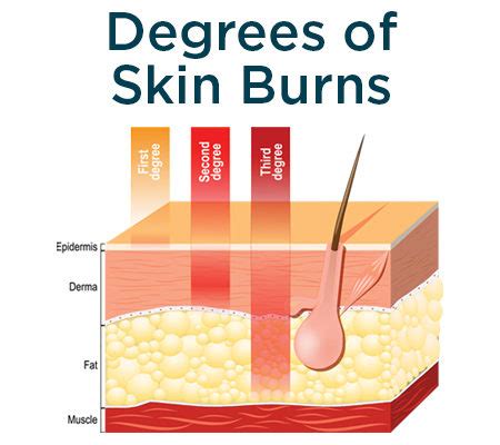 When should you see a doctor about a second-degree burn?