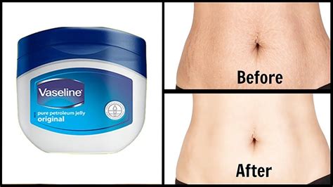 When should you stop putting Vaseline on a scar?