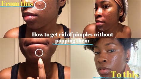 Where does a pimple go if you don't pop it?