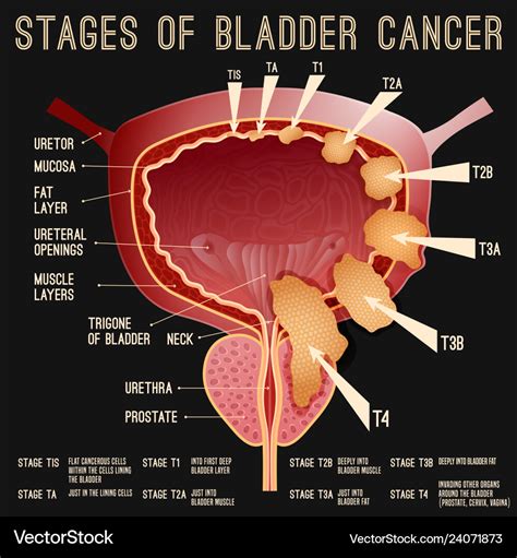 Where does bladder cancer begin?