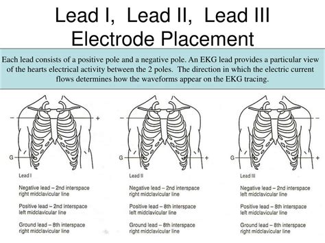 Where is lead 3 placed?