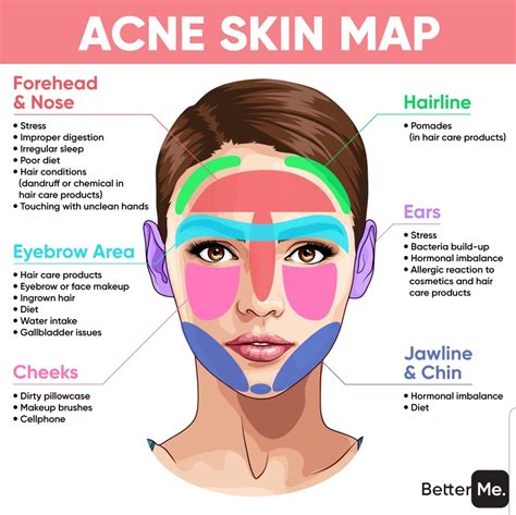 Where is stress acne located?
