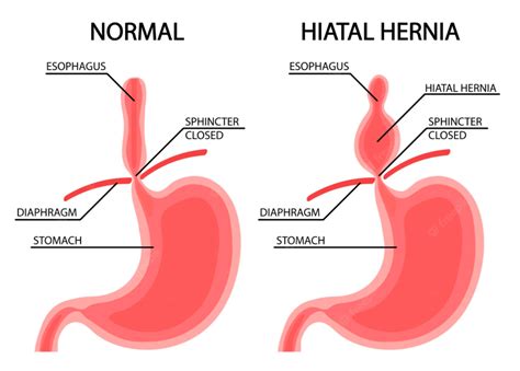 Where is the pain with a hiatal hernia?