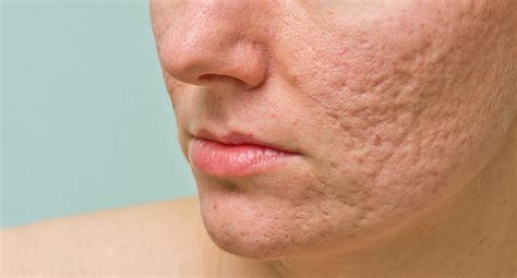 Which acne scars are not permanent?