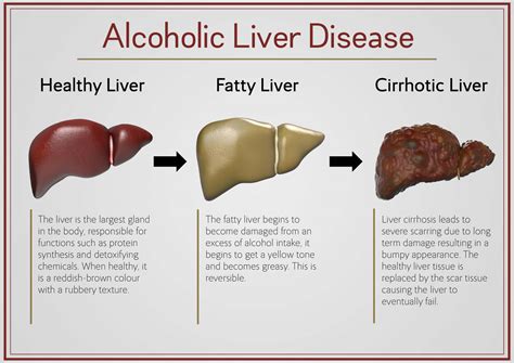 Which alcohol is hardest on liver?