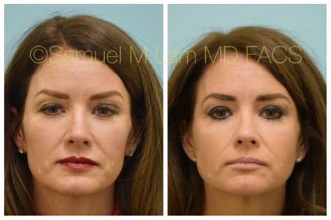 Which facial is best for 45 year old woman?