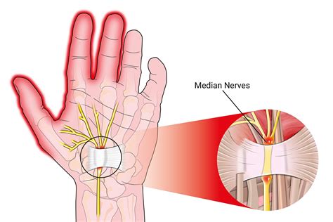 Which finger is most affected by carpal tunnel?