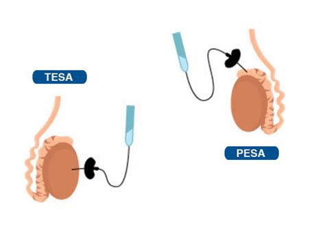 Which is better PESA or Tesa?