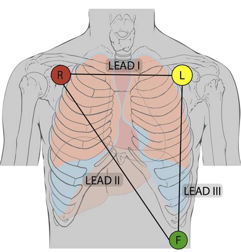 Which lead is lead 3?