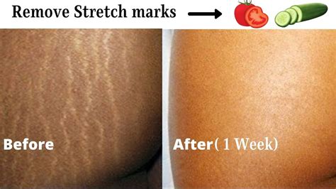 Which oil can fade stretch marks?