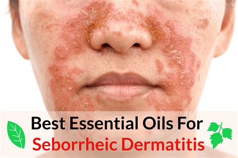 Which oil is best for seborrheic dermatitis?