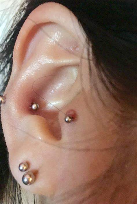 Which piercings are most likely to get keloids?