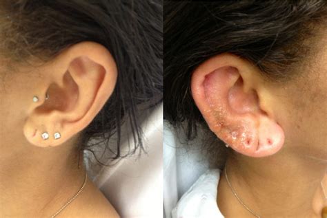 Which piercings can cause nerve damage?