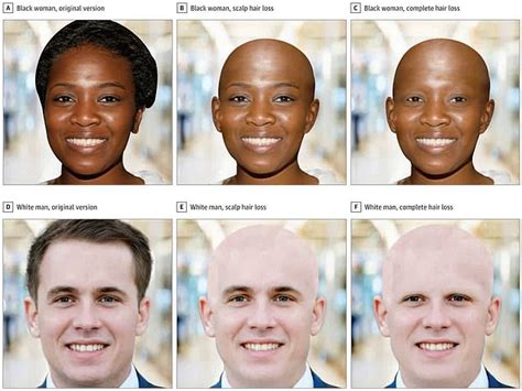 Which race is most likely to go bald?