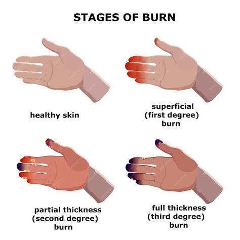 Which stage of burn is painless?