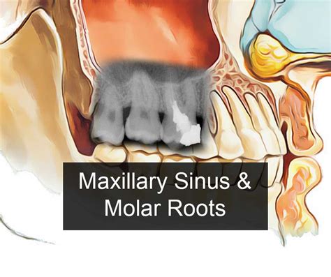Which teeth are connected to the sinuses?