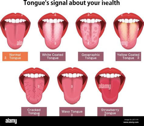 Which tongue is healthy?