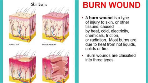 Which type of burn is most likely to leave a scar?
