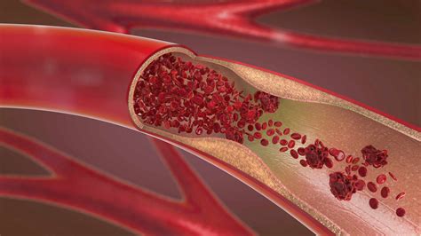 Which vitamin deficiency causes plaque in arteries?