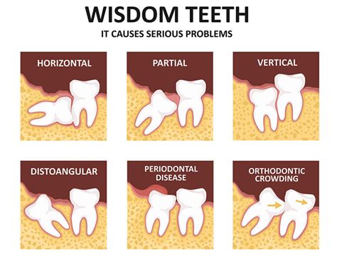 Which wisdom teeth are worse to remove?