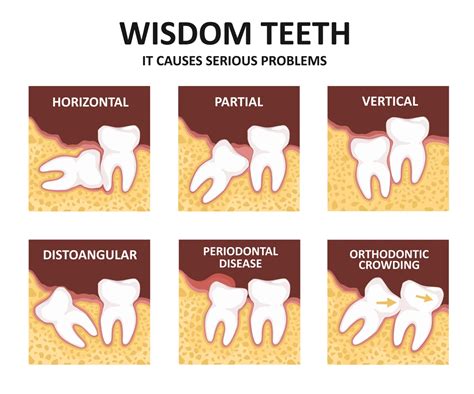 Which wisdom teeth hurt the most?