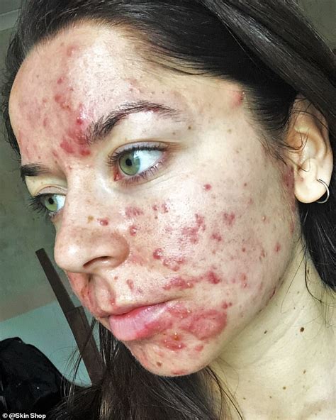 Who gets the worst acne?