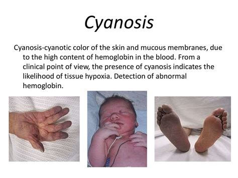 Who is at risk for cyanosis?