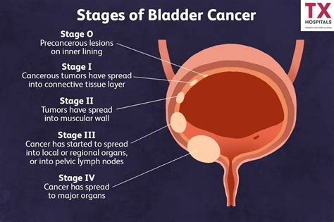 Who is at risk of bladder cancer?