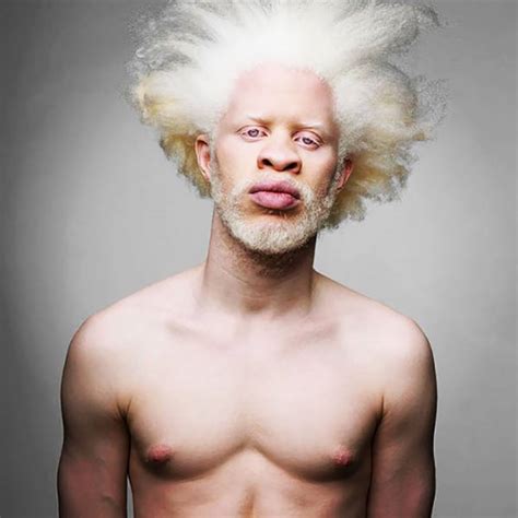 Who is the Brazilian albino singer?
