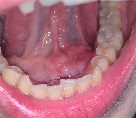 Who should I see for a lump in my mouth?
