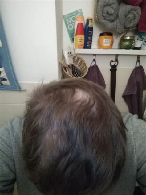 Why am I 15 with a bald spot?