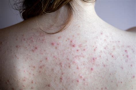 Why am I getting acne on my back shoulders?