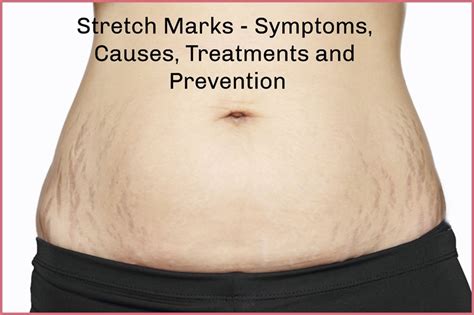 Why am I getting stretch marks if I'm not gaining weight?