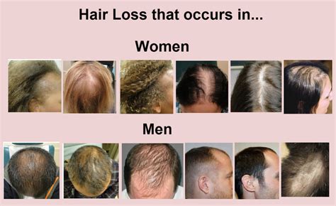 Why am I losing hair after keratin?