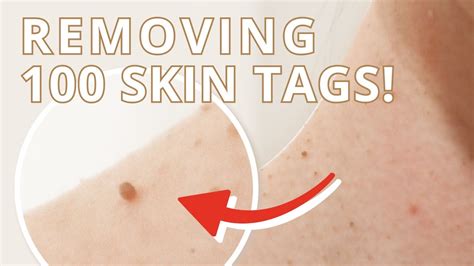 Why am I suddenly getting skin tags on my neck?