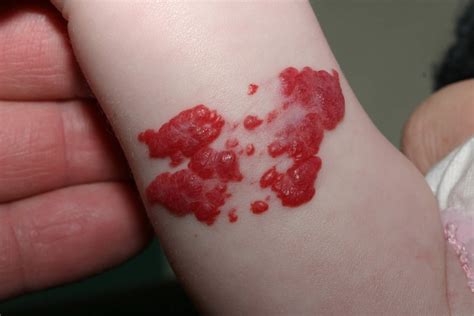 Why are babies born with red birthmarks?