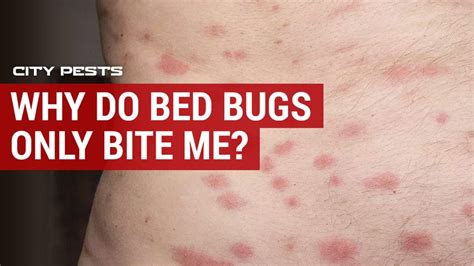 Why are bed bugs biting me but not my husband?