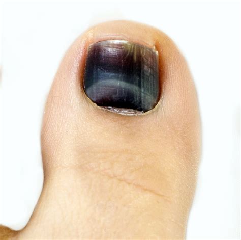 Why are big toe nails black?