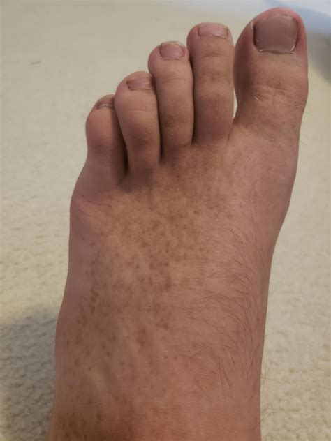 Why are my feet so pigmented?