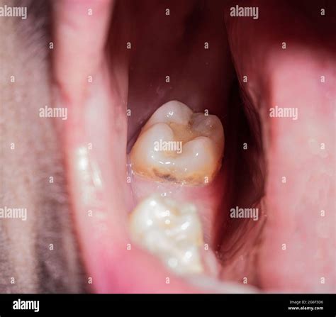 Why are my gums so slow to heal after tooth extraction?