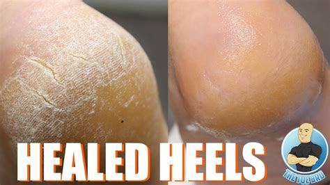 Why are my heels still dry after pedicure?