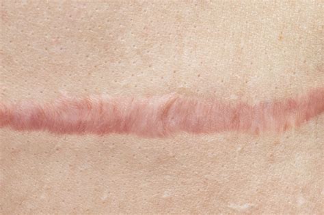 Why are my scars so visible?