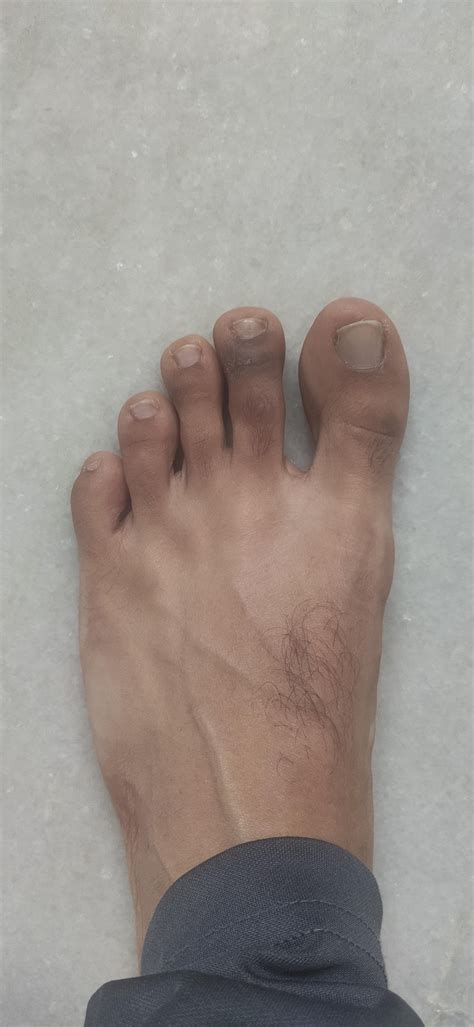 Why are my toes turning brown?