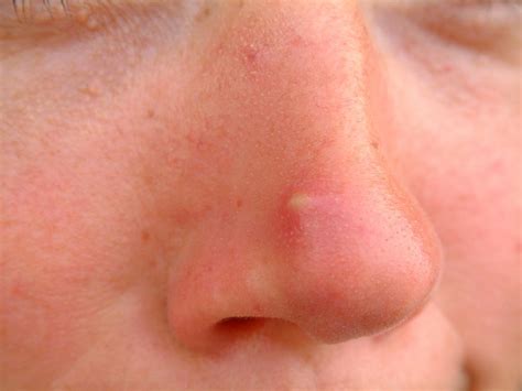 Why are nose pimples so big?