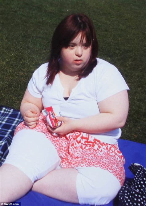 Why are people with Down syndrome chubby?