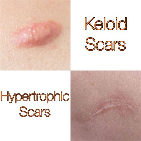 Why are scars pale?